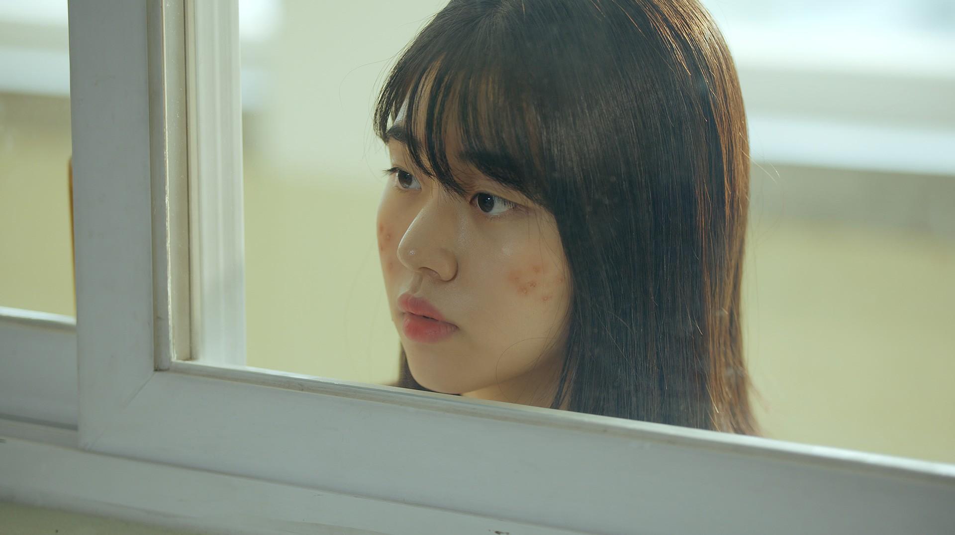 여드름과 함께 춤을